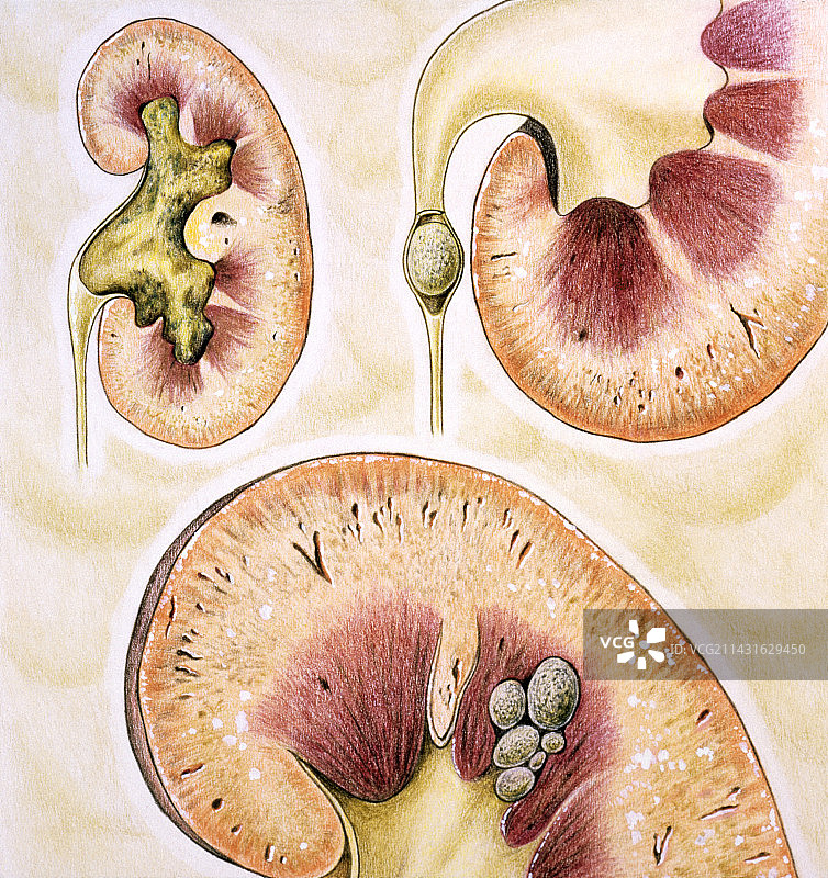 不同类型的肾结石艺术作品图片素材