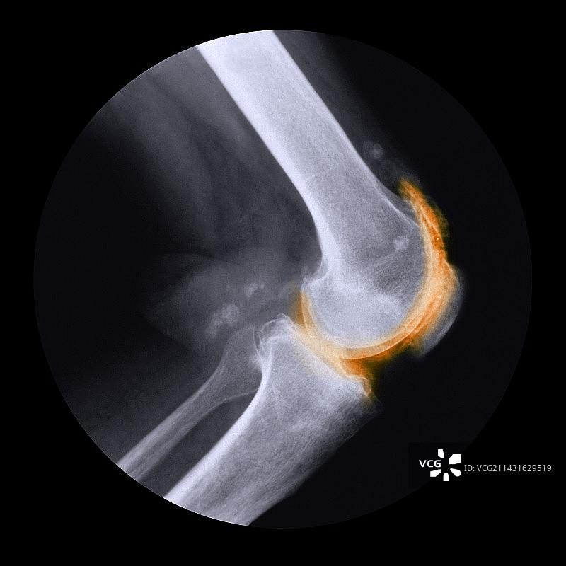 膝关节炎X光片图片素材