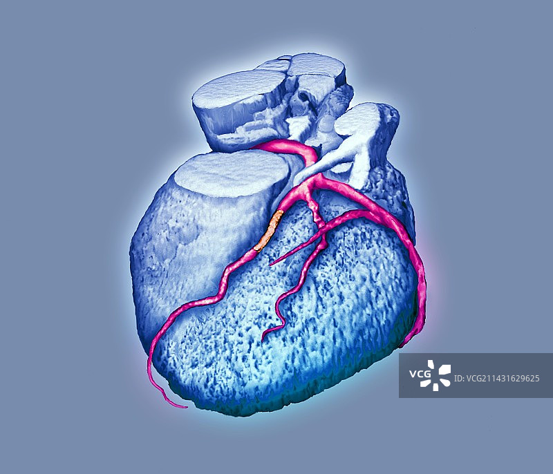 冠状动脉血管成形术，CT扫描图片素材