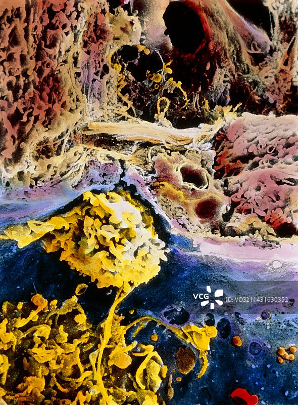 受肝硬化影响的肝细胞的彩色扫描电镜图图片素材