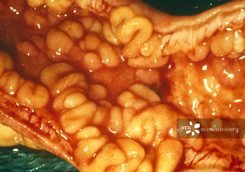 切除回肠中的克罗恩病图片素材