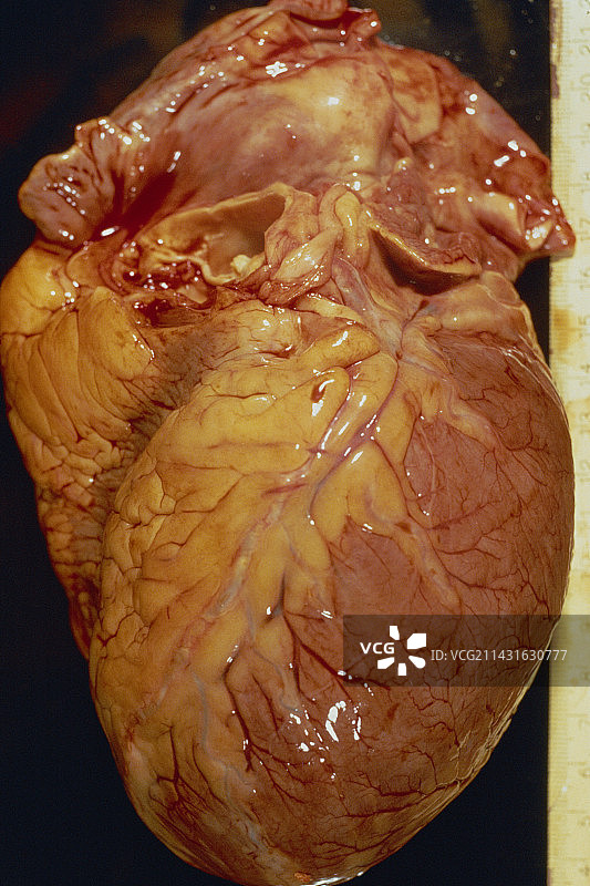 心脏扩大图片素材