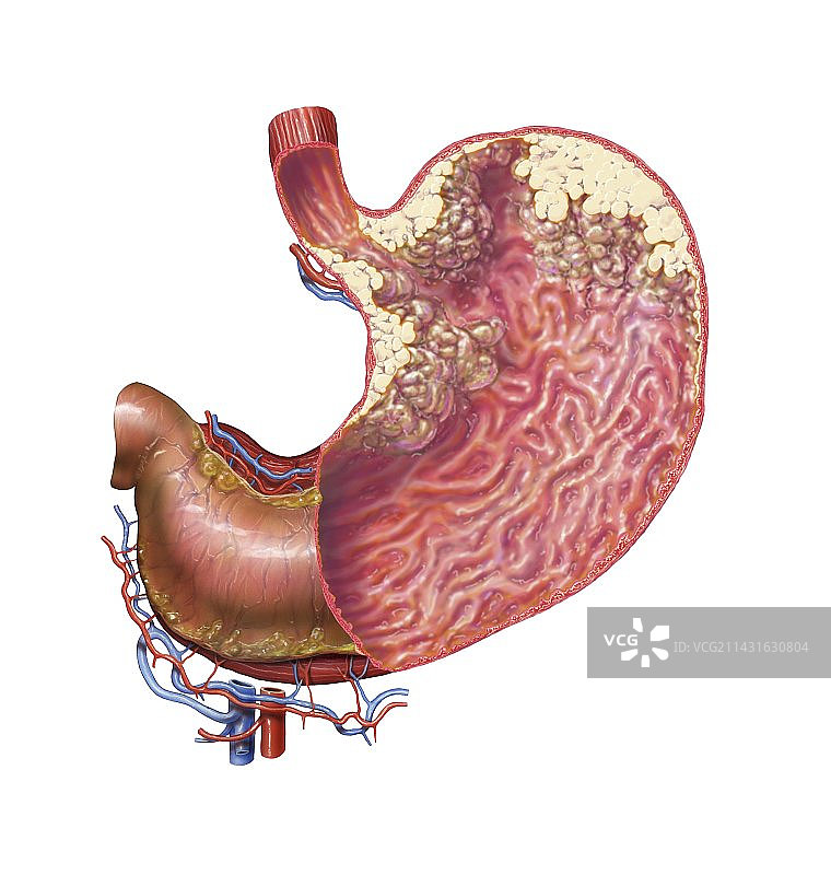 胃癌医学插图图片素材