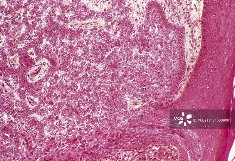 皮肤癌浅显显微照片图片素材
