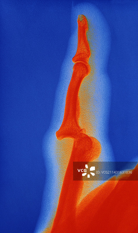 手指脱臼图片素材