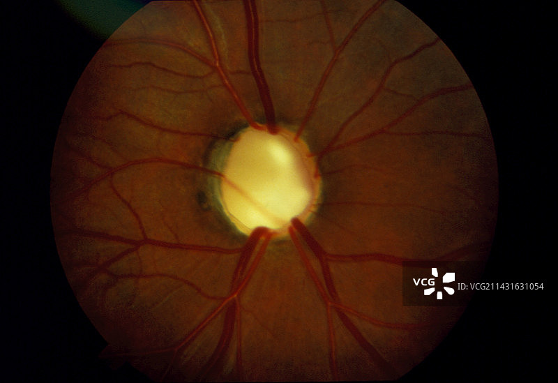 晚期青光眼:视盘拔火罐图片素材