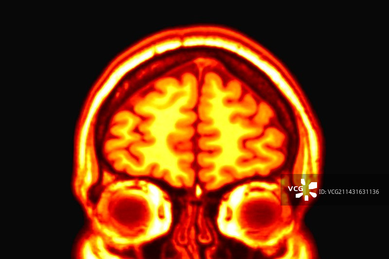 大脑核磁共振扫描图片素材