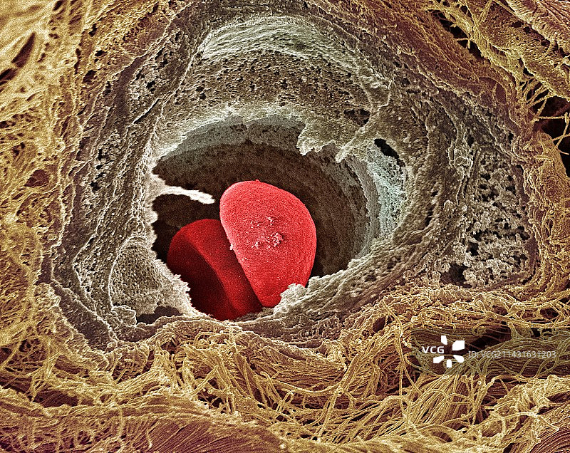 乳腺癌图片素材