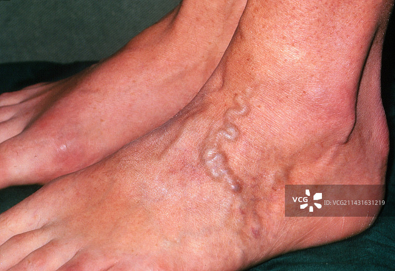 静脉曲张图片素材