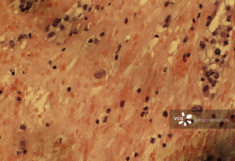 显示霍奇金病的活组织检查图片素材