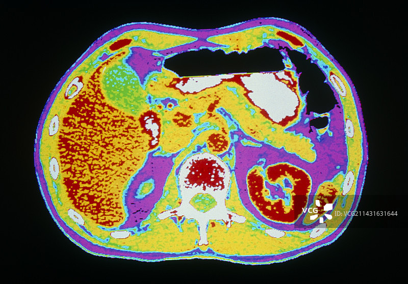 肝脏/胆囊/胰腺的伪彩色CT扫描图片素材