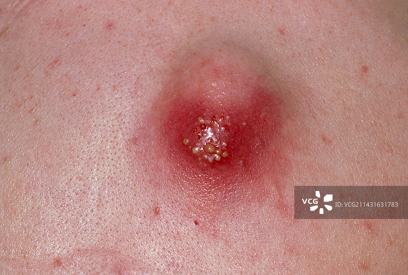 特写：背部感染的皮脂囊肿图片素材