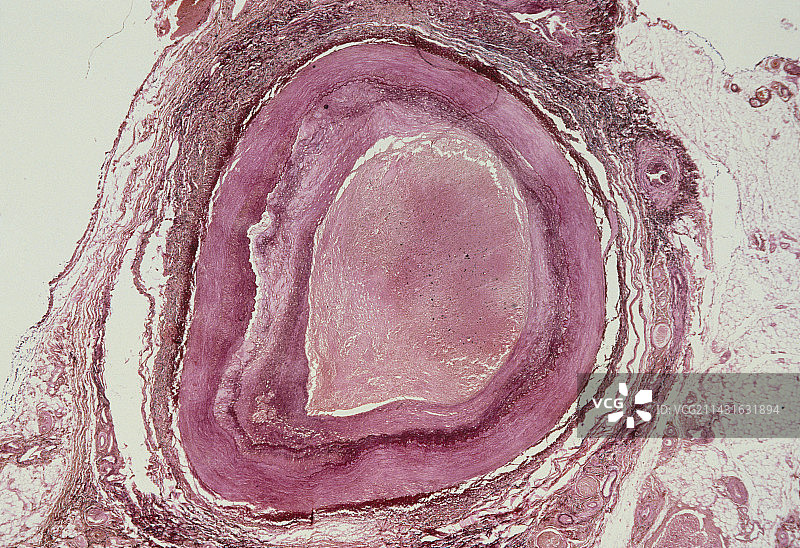 动脉疾病图片素材