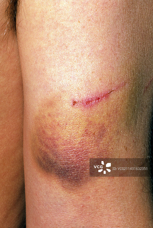 第4天划伤瘀伤手臂特写图片素材