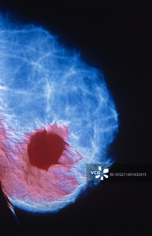彩色乳腺癌X光检查图片素材