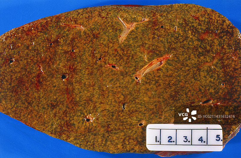 受肝硬化影响的肝脏横截面图片素材