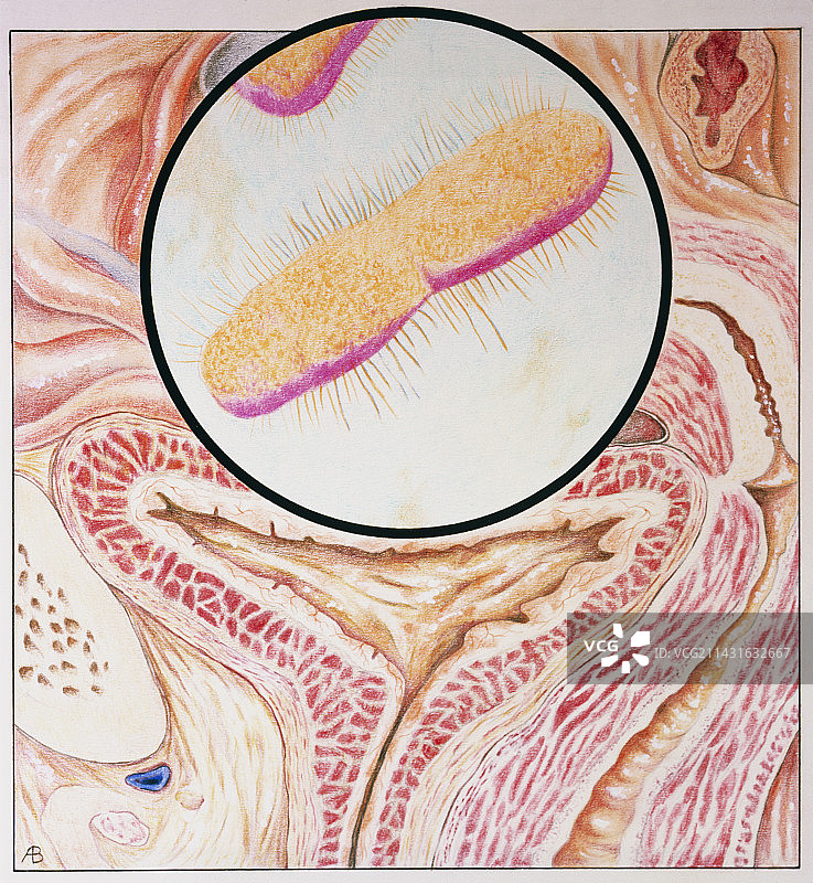 膀胱炎(膀胱炎症)插画图片素材