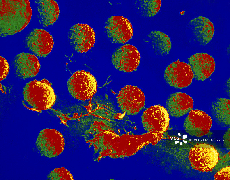 骨髓中白血病淋巴母细胞的彩色扫描电镜图片素材