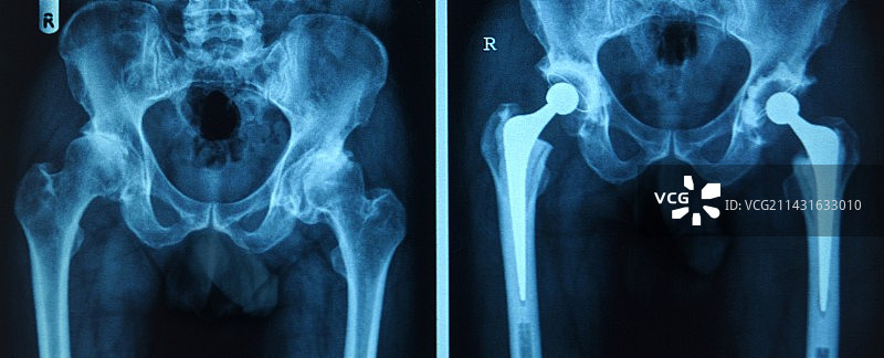 髋关节置换X光片图片素材