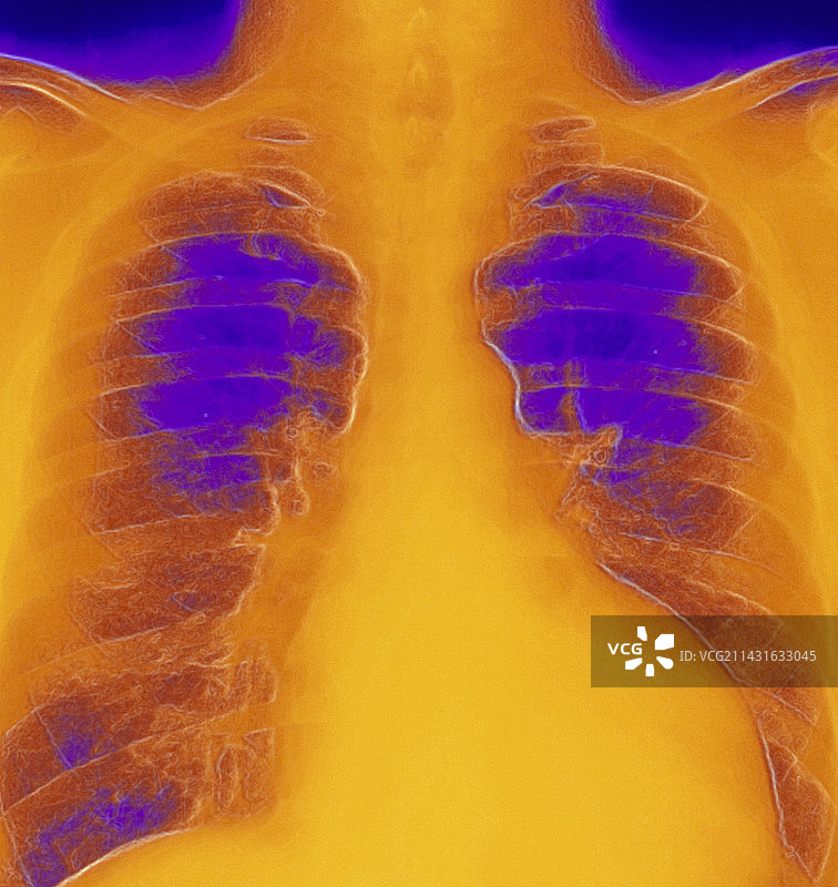 彩色心肌病胸部X光片图片素材