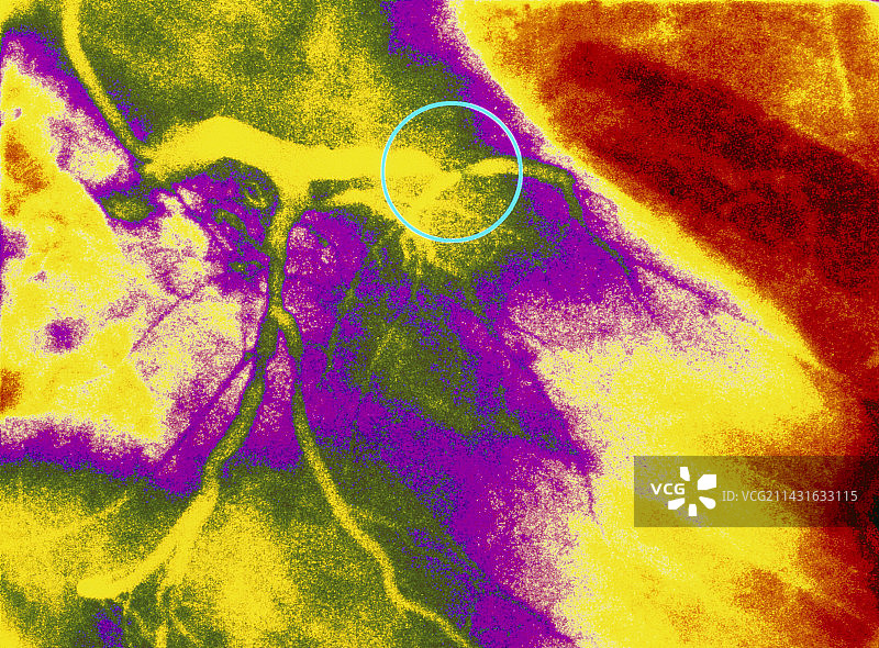 左冠状动脉狭窄的彩色血管造影图片素材