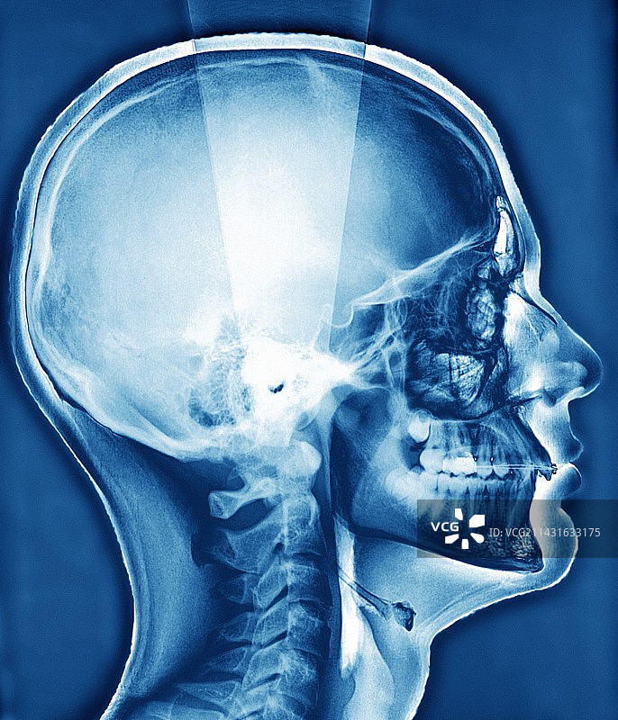 正畸牙箍X光片图片素材