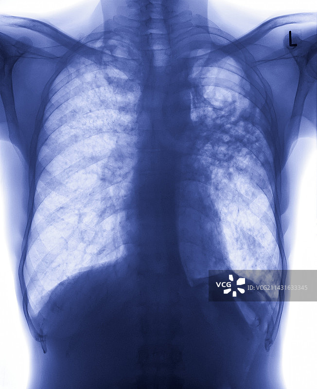 肺结核X光片图片素材