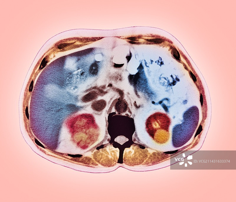 肾肿瘤,CT扫描图片素材