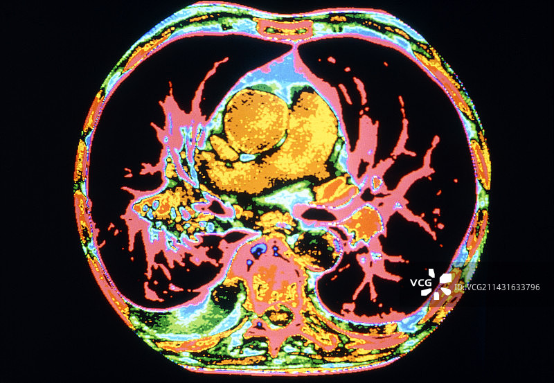 显示肺炎肺部的CT扫描图片素材