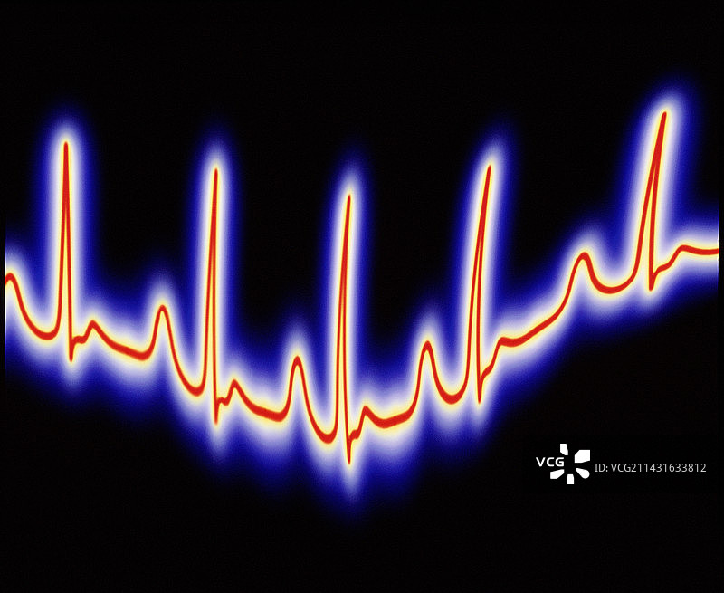 心脏病:不规则心电图痕迹的艺术品图片素材