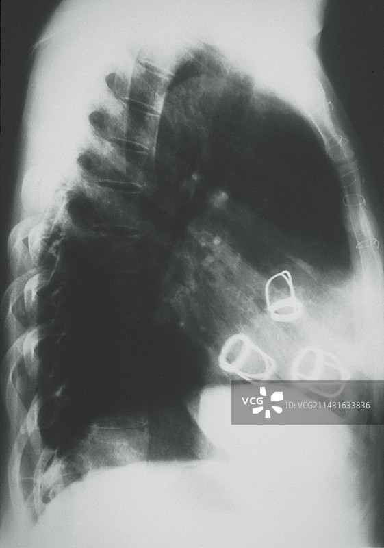 原位人工心脏瓣膜的X光片图片素材