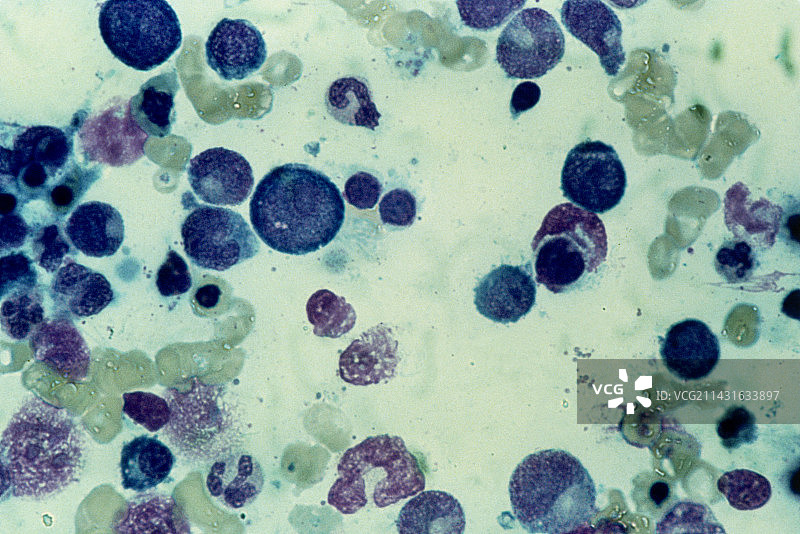 巨成红细胞性贫血骨髓的光学显微镜图图片素材