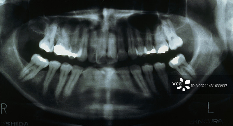 显示带填充物的牙齿的全景X光片图片素材