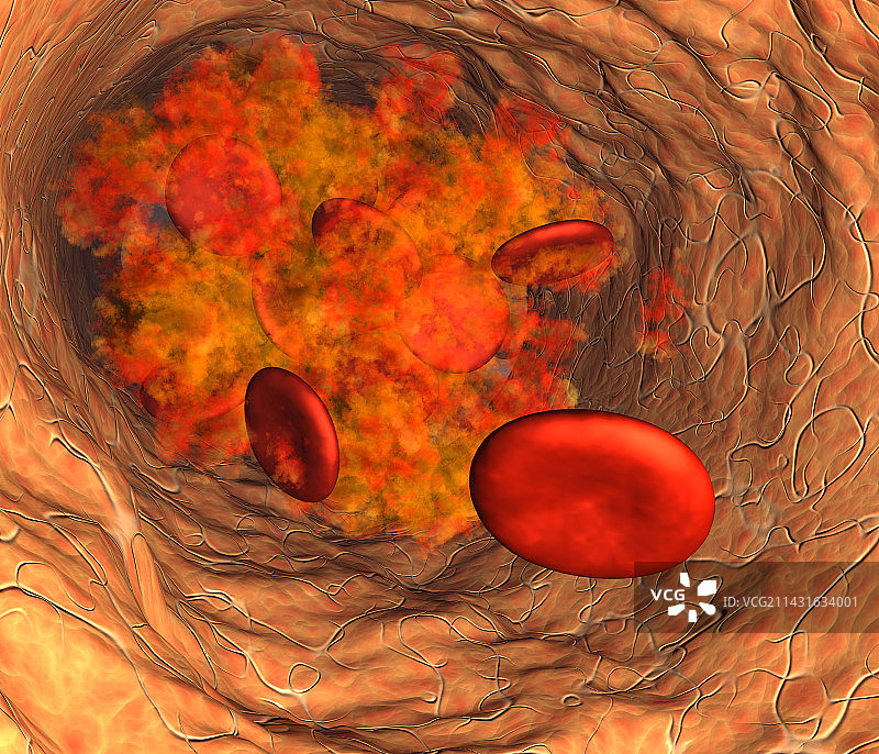 血凝块图片素材