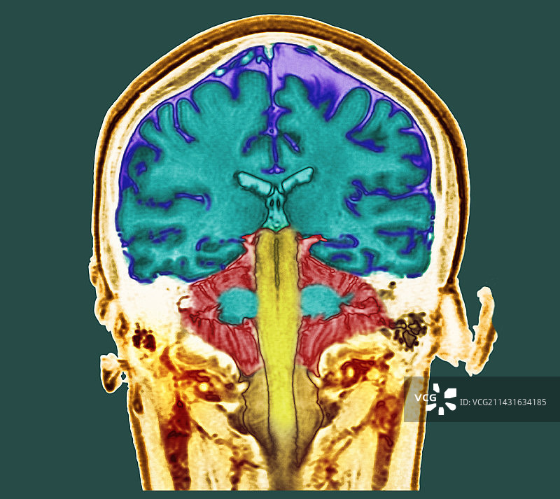 健康的大脑核磁共振扫描图片素材