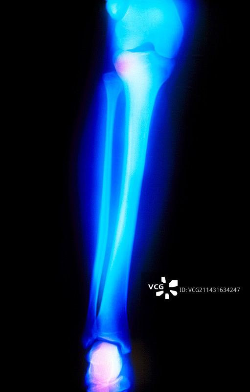 彩色X光下的青年人小腿图片素材