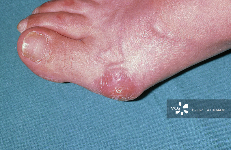 女性脚上的拇囊炎图片素材