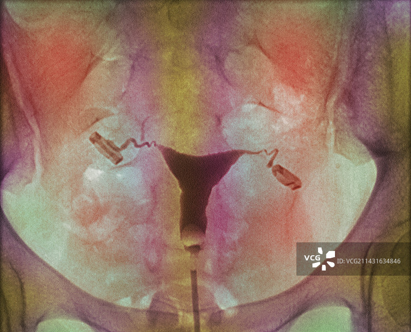 女性生殖系统图片素材