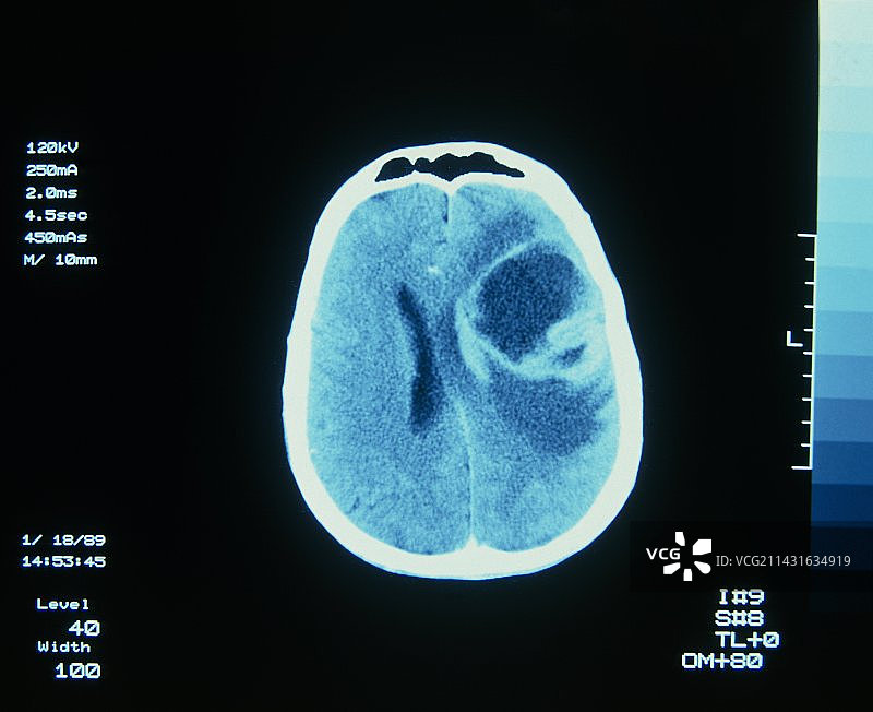 脑部CT扫描图片素材