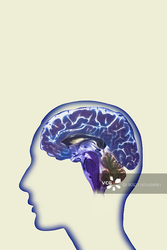 脑部MRI扫描图片素材