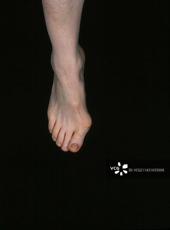 女性的拇外翻图片素材