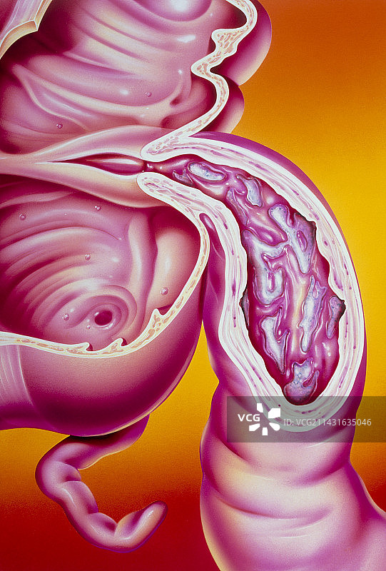 回肠克罗恩病插画图片素材