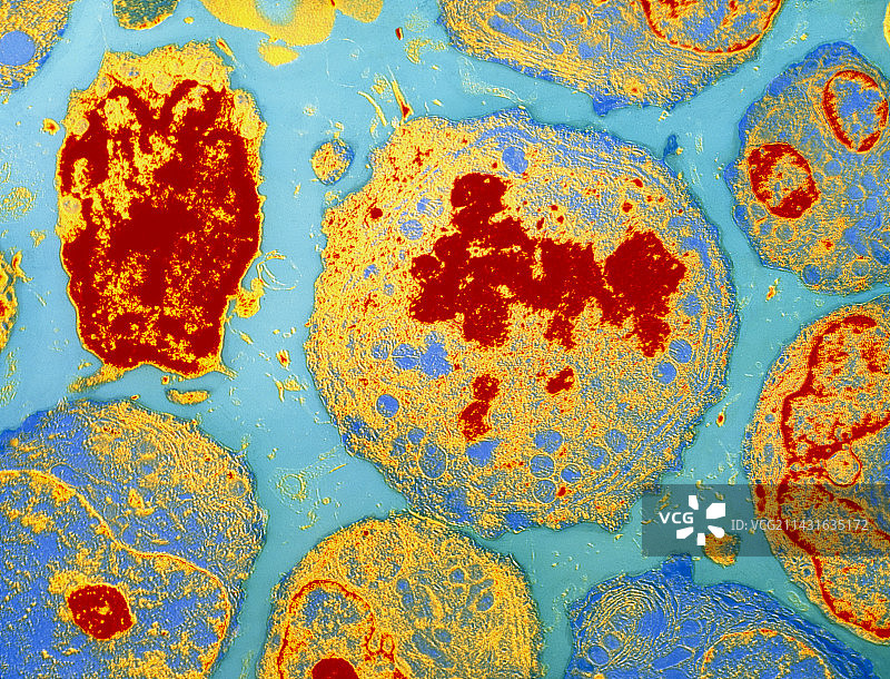 癌细胞彩色透射电子显微镜图像图片素材