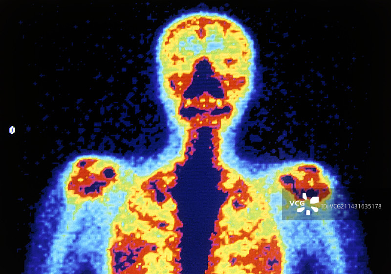 彩色放射性核素骨骼扫描（上半身）图片素材