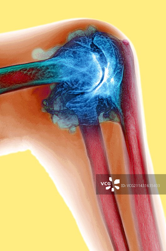 关节炎肘部X光片图片素材