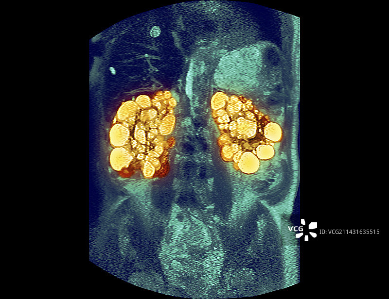 多囊肾核磁共振扫描图片素材