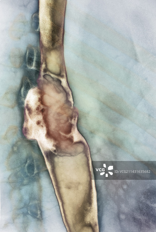 食道癌X光片图片素材