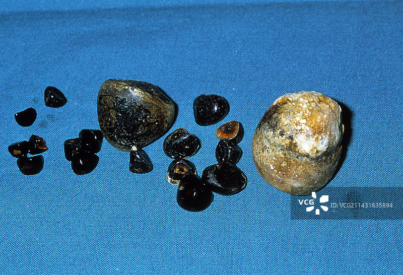 胆结石图片素材