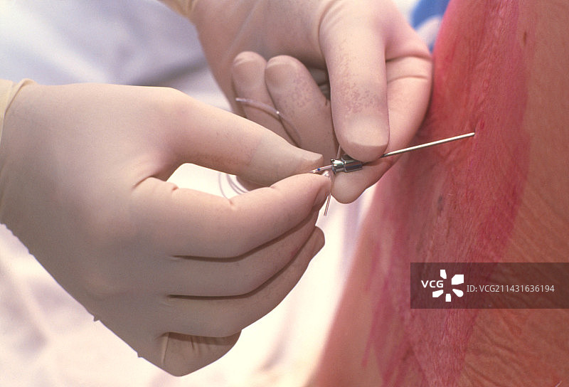 医生插入导管进行硬膜外麻醉图片素材