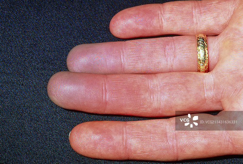 女性手指上出现的雷诺现象图片素材